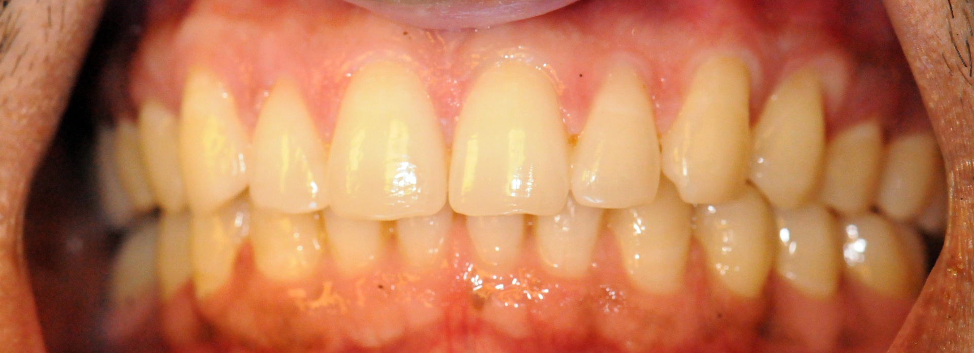 D Dental Office | Teeth Whitening - Before